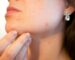 recomendaciones acne