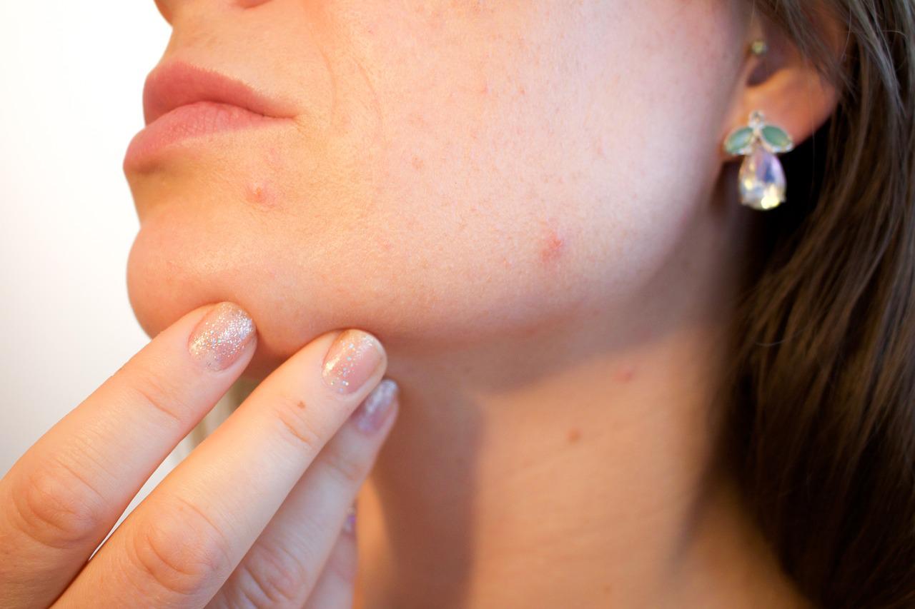 recomendaciones acne